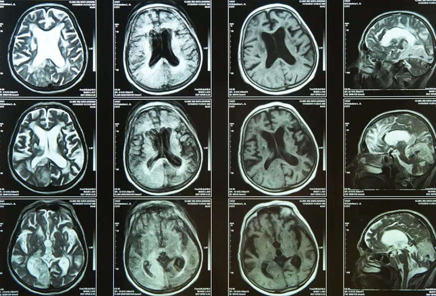 Alzheimer’s disease image blog